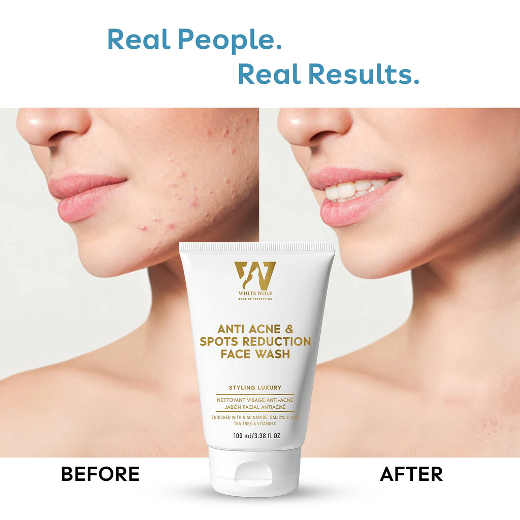 Anti Acne & Spots Reduction Face Wash