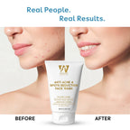 Anti Acne & Spots Reduction Face Wash