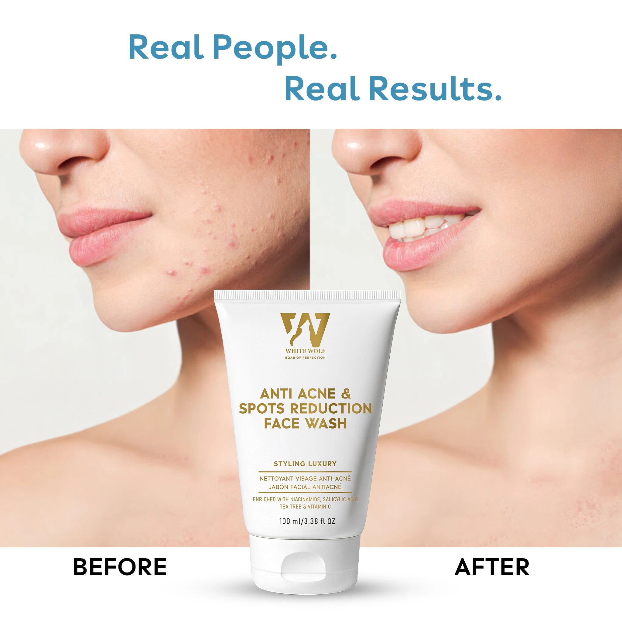 Anti Acne & Spots Reduction Face Wash