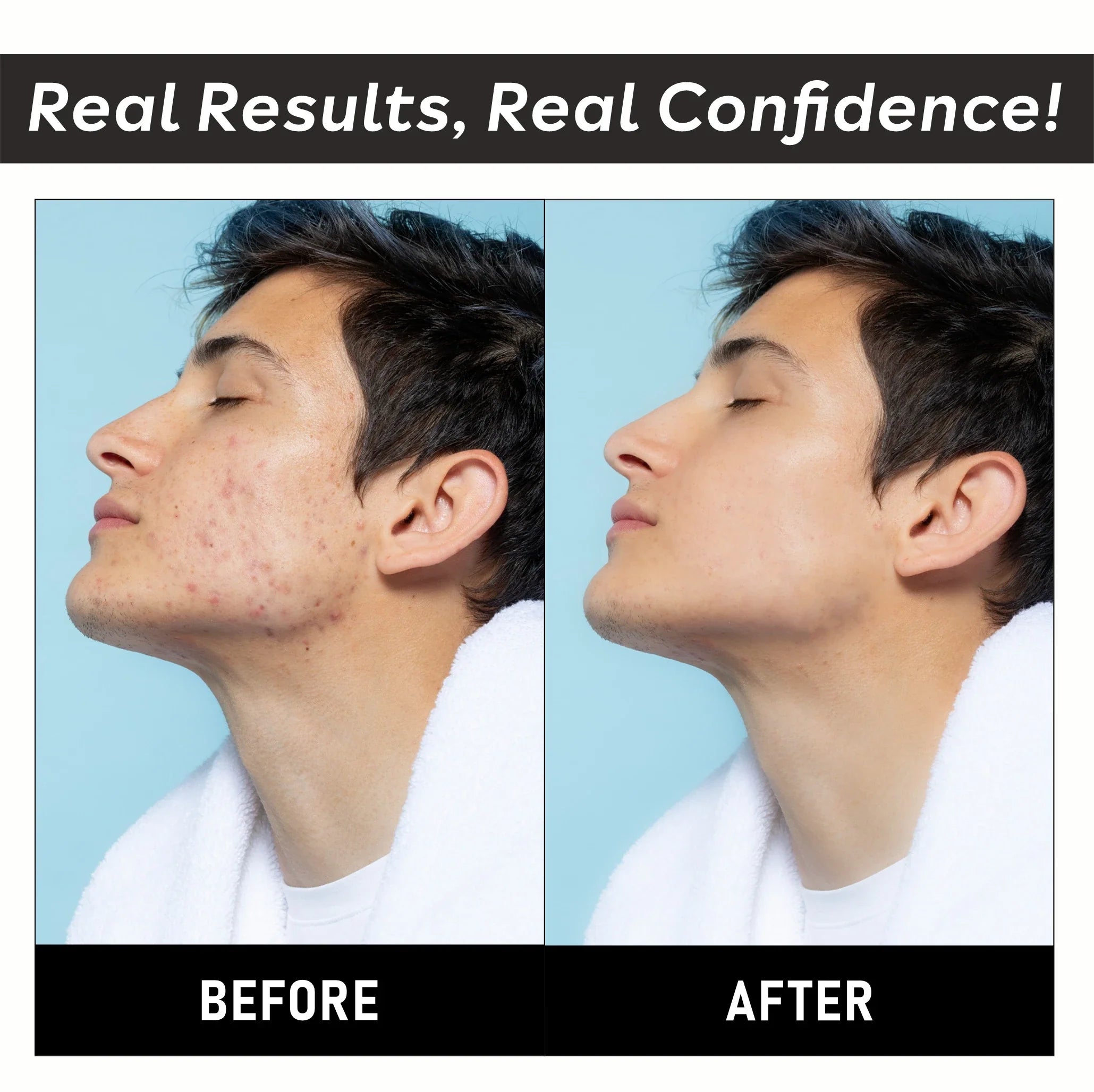 Anti Acne & Spots Reduction Face Wash